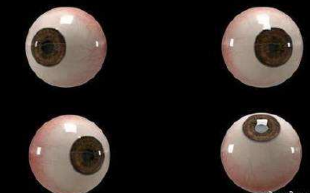 世界首個(gè)3D人工眼球問(wèn)世，數百萬(wàn)人將重見(jiàn)光明